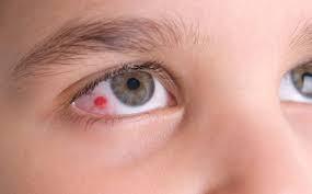 اسباب وعلاج نزيف العين ومضاعفاته وخطورته